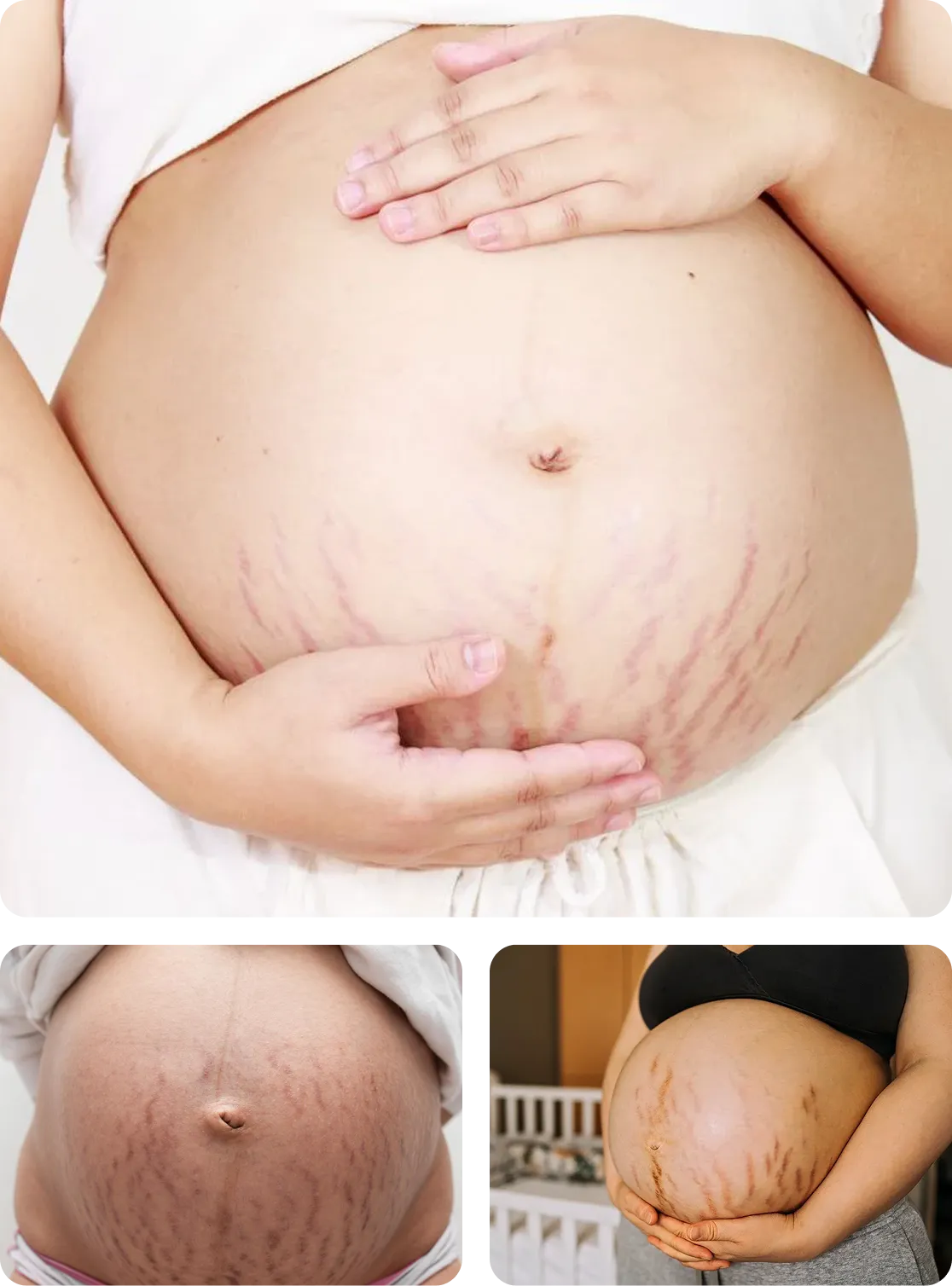 Three close-up images of pregnant bellies with visible stretch marks; each person holds or supports their belly with their hands, highlighting the stretch marks on their skin.
